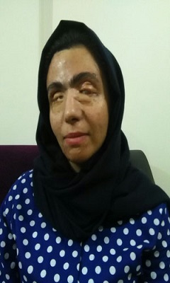 قربانیان اسیدپاشی چگونه زندگی می کنند؟/ عکس قربانیان اسیدپاشی چگونه زندگی می کنند؟/ عکس