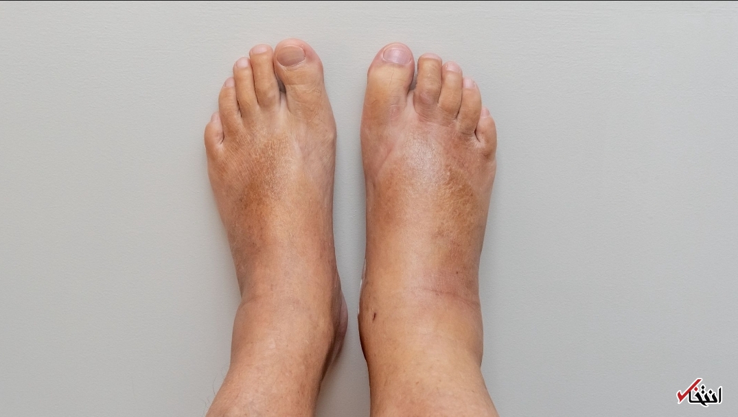 ورم پا یک عارضه ساده نیست/ از نارسایی قلبی تا اختلال در سیستم لنفاوی