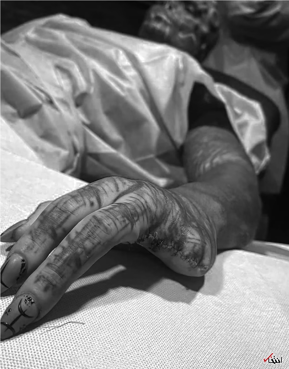 عجیب&zwnj;ترین جراحی زیبایی جهان/قطع انگشتان دست برای ایجاد پنجه! +تصاویر