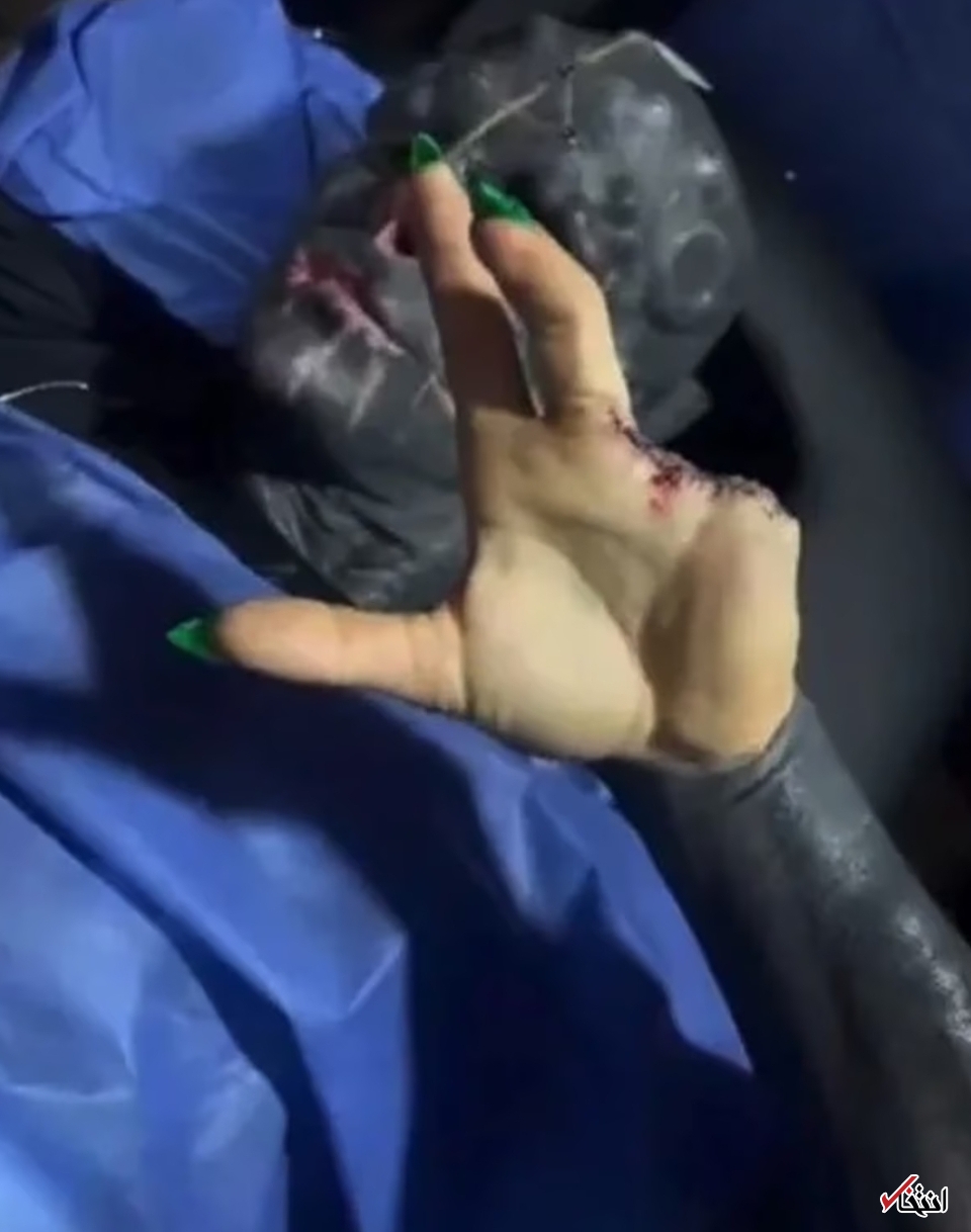 عجیب&zwnj;ترین جراحی زیبایی جهان/قطع انگشتان دست برای ایجاد پنجه! +تصاویر