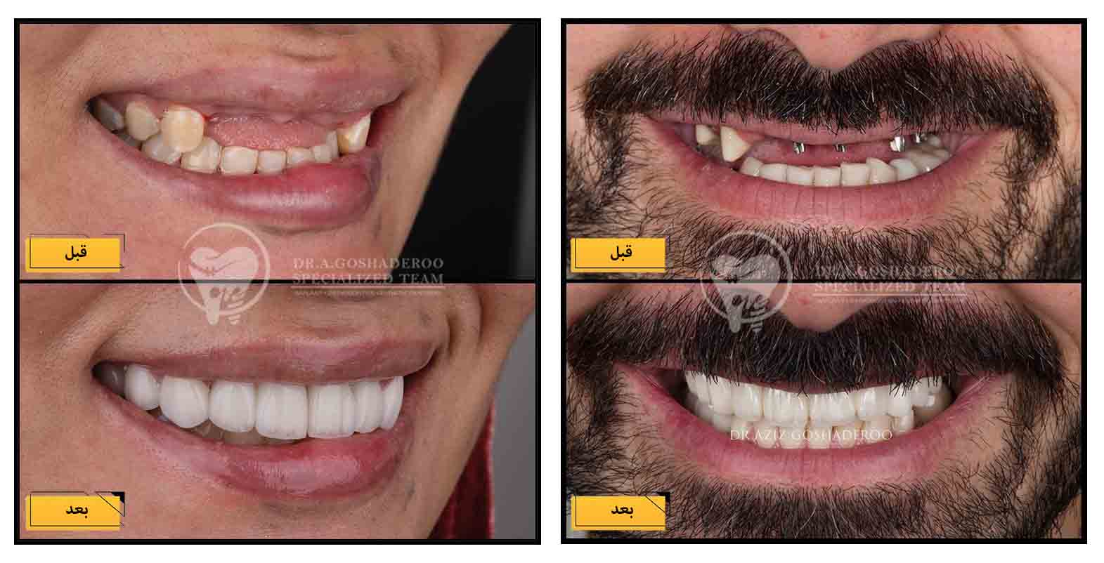 کاشت ایمپلنت دندان برای چه کسانی توصیه میشود؟