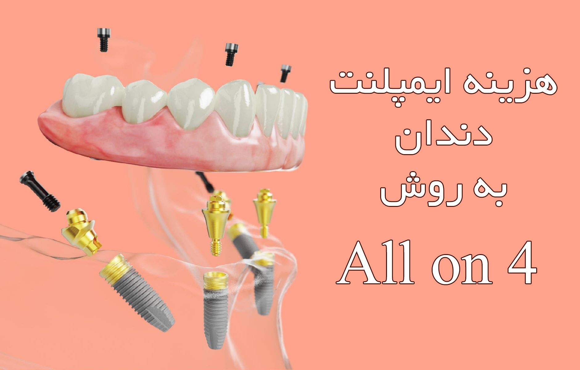 هزینه ایمپلنت دندان به روش All On 4