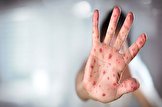 ابتلای یک کودک ۹ ماهه به سرخک در قم