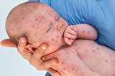 افزایش ۷۹ درصدی موارد ابتلا به سرخک در جهان
