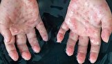 آبله میمون از طریق هوا منتقل نمی‌شود/ انتقال از طریق تماس نزدیک با زخم