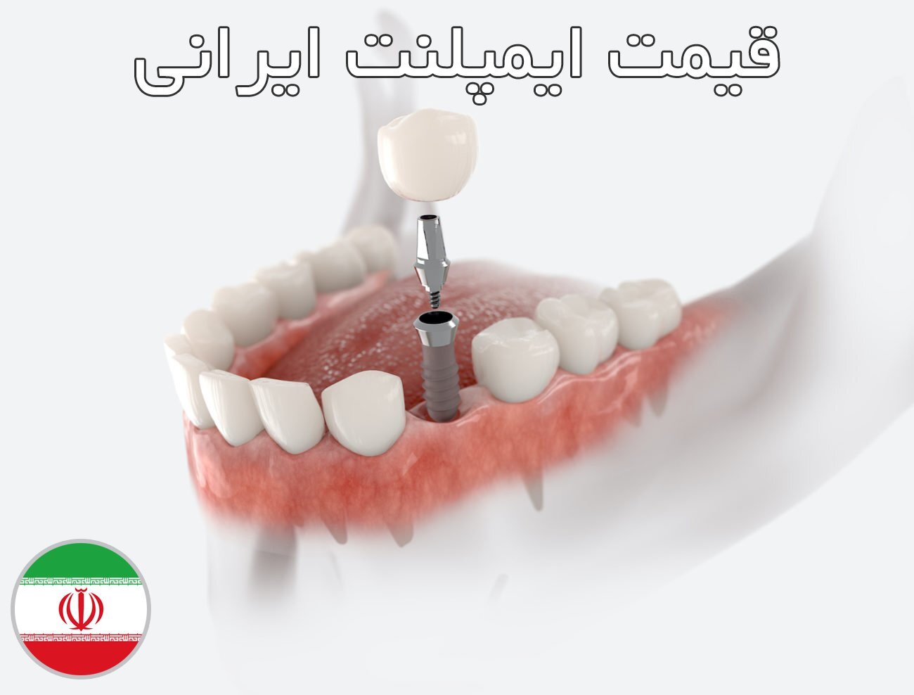 قیمت ایمپلنت ایرانی