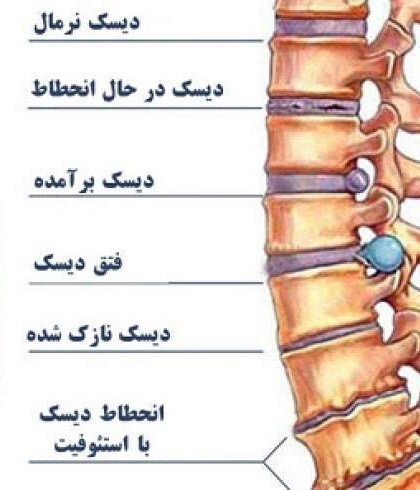 آیا همه دیسکهای بیرون زده ناحیه کمر و گردن دیگر نیاز به جراحی دارند؟ آیا همه دیسکهای بیرون زده ناحیه کمر و گردن دیگر نیاز به جراحی دارند؟