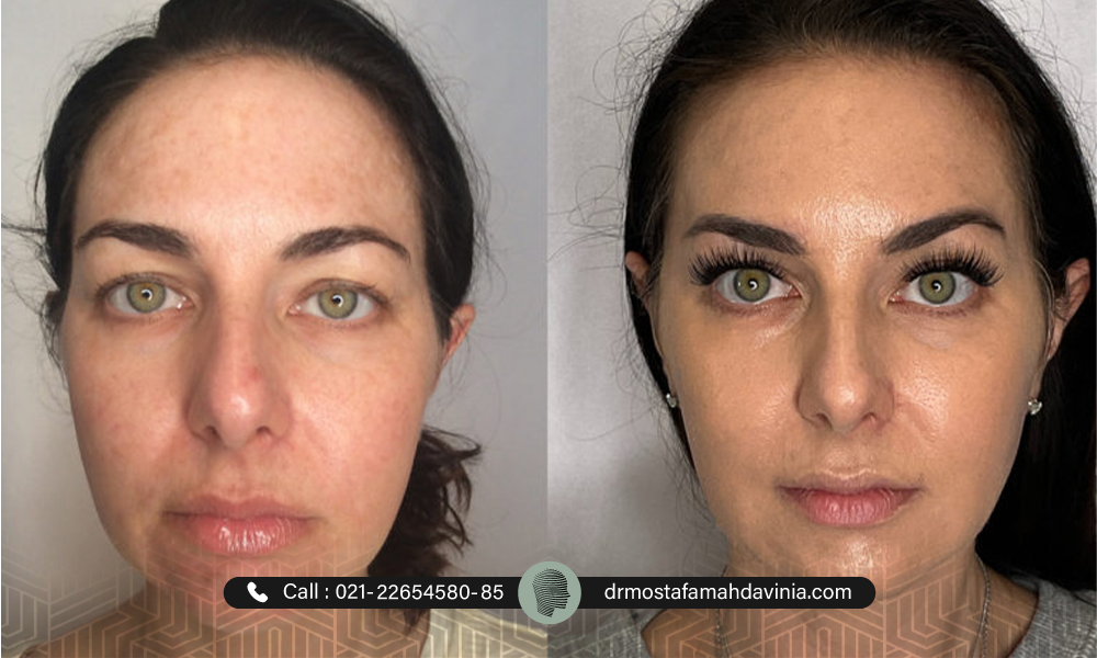 در لیفت نخ امکان پارگی نخ‌ها وجود دارد؟