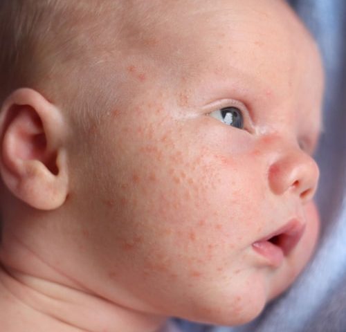 آکنه نوزادی: روش تشخیص و درمان آن