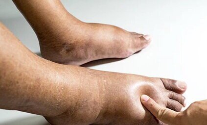 چرا ورم ناگهانی پا را باید جدی گرفت؟