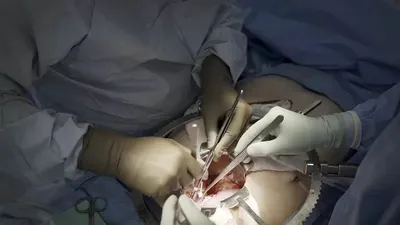 پیوند اندام حیوانات به انسان؛ کلیه خوک پیوندی پس از یک ماه هنوز به صورت نرمال کار می‌کند
