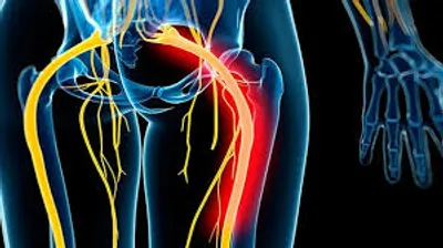 5 روش خانگی برای تسکین درد سیاتیک
