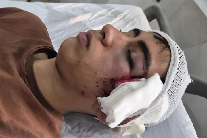 مصدومیت شدید دانشآموز دهبکری بم توسط معلم / پدر این دانشآموز: معلم کلاس با دسته صندلی به سر و صورت فرزندم کوبیده / سال گذشته نیز همین معلم با پرخاشگری لفظی، گلوی فرزندم را بهگونهای فشرد که نزدیک بود خفه شود