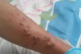 ثبت دو مورد مشکوک ابتلا به آبله میمون در افغانستان